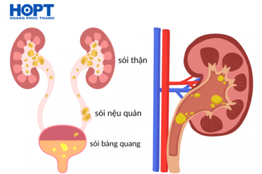 Chỉ định và chống chỉ định Phẫu thuật nội soi trong điều trị Sỏi thận